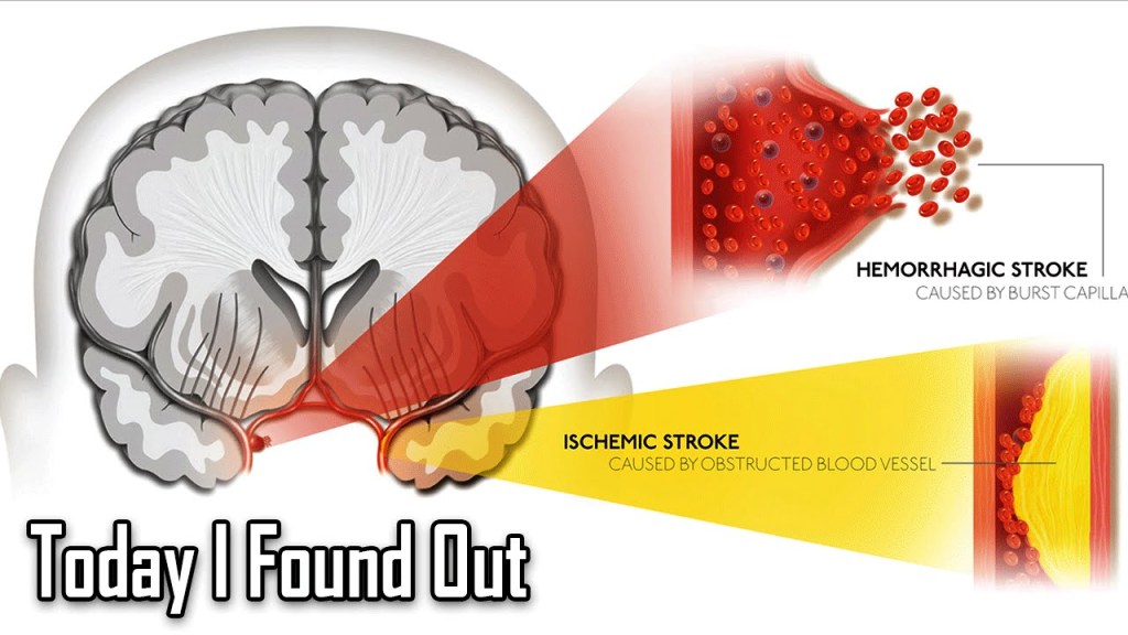 The Physiological Factors Behind Two Different Types of Strokes