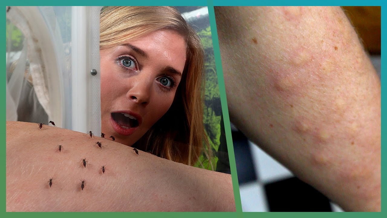 BBC Earth Unplugged Host Allows Herself to Get Bitten by Mosquitos to  Understand Them Better