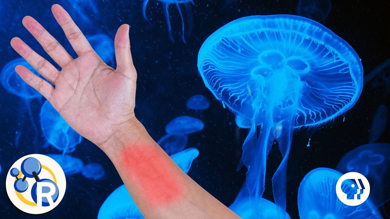 Why Urine Doesn't Work to Treat a Jellyfish Sting