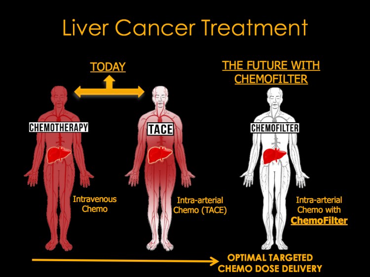 Liver Cancer Chemofilter