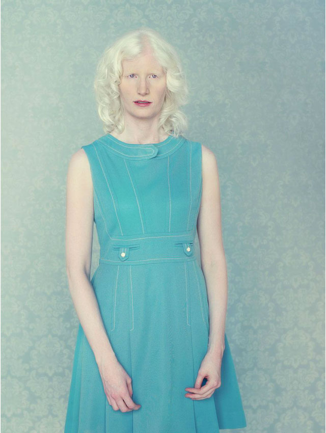 Albinism treatment image